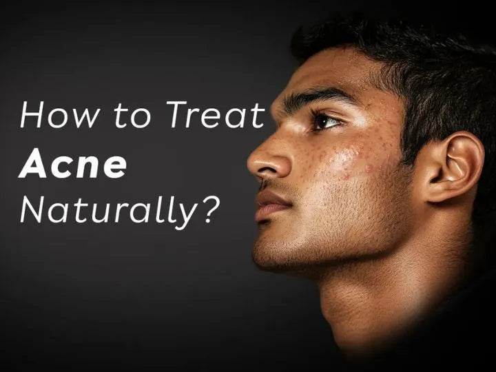 How to Treat Acne Naturally? - White Wolf India