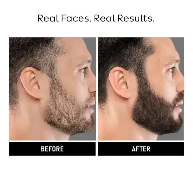 beard growth results of beard on face